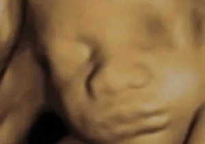 3D Ultrasounds