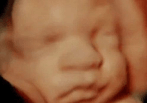 4D Ultrasounds