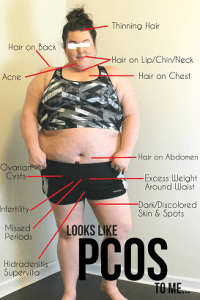 Common symptoms of PCOS