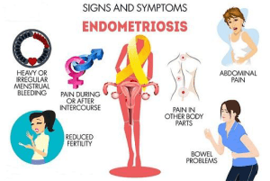 Endometriosis