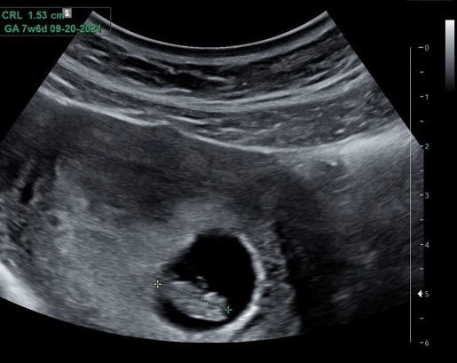 First Trimester Combined Screening FTS