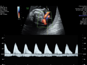 Foetal echo