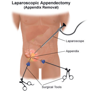 LAPAROSCOPIC SURGERY
