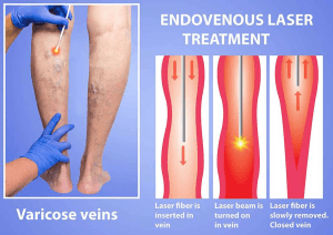 Laser Ablation