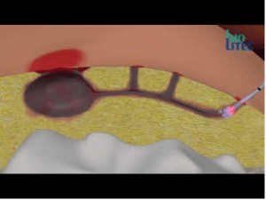Laser pilonidal sinus surgery