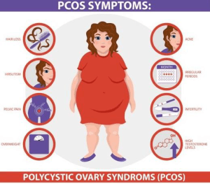 Obesity Polycystic Ovary Syndrome PCOS