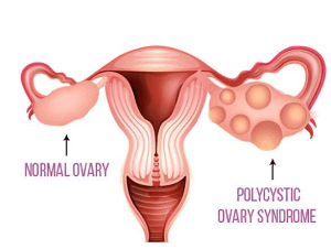 PCOS