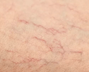SPIDER VEINS