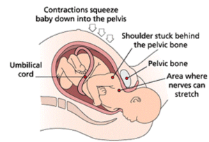 Shoulder dystocia 1
