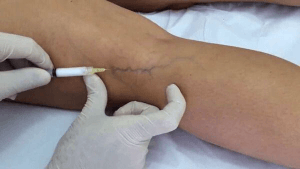 Ultrasound Guided Foam Sclerotherapy
