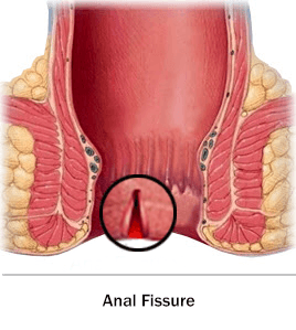 anal fissure