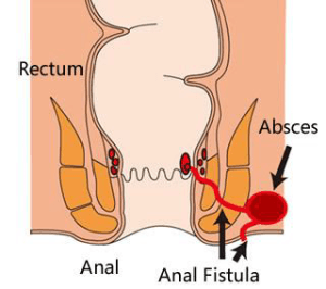 anal fistula