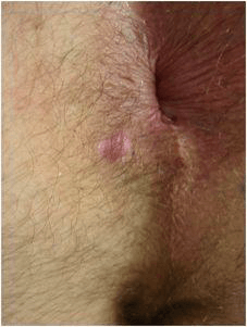 anal fistula2