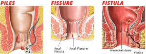 anorectal diseases