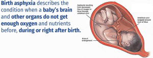 birth asphyxia 1