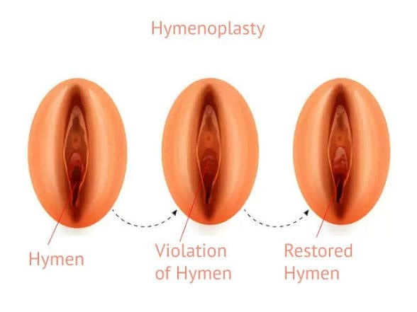 Diagram showing the hymen, a violated hymen, and a restored hymen after hymenoplasty