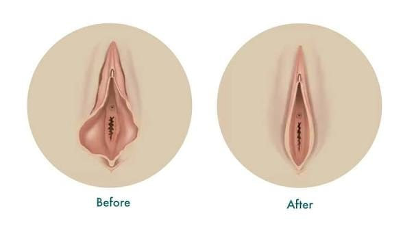 Diagram comparing labia before and after labiaplasty