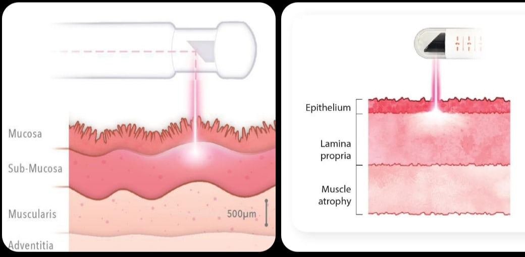 Diagram showing laser energy applied to the layers of vaginal tissue