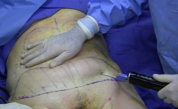 Illustration of liposuction body contouring