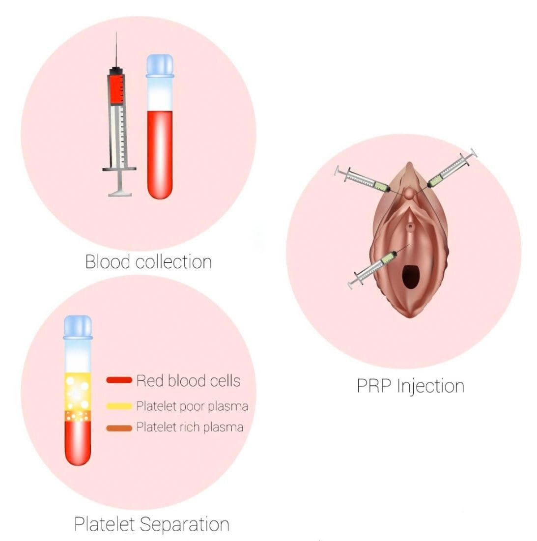 Diagram of the PRP process: blood collection, platelet separation, and injection