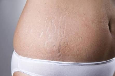 Stretch marks on the abdomen after pregnancy