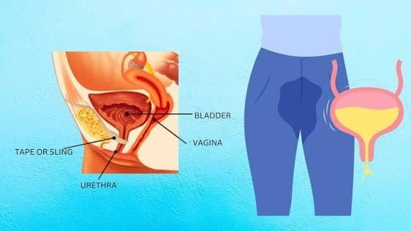 Anatomical diagram showing the bladder, urethra and vagina in stress urinary incontinence