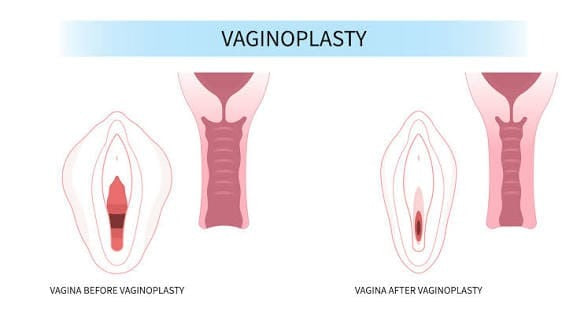 Diagram comparing vaginal anatomy before and after vaginoplasty