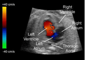 echocardiography