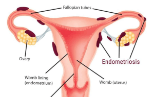 endometriosis 2