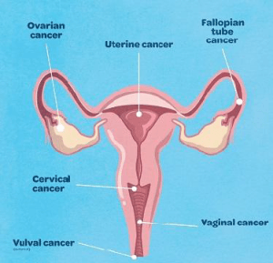 gynecologic malignancy