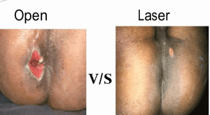 laser treatment