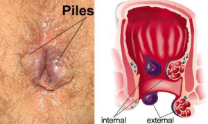 piles