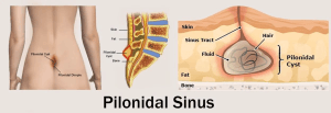 pilonidal