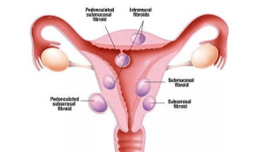 uterine fibroids