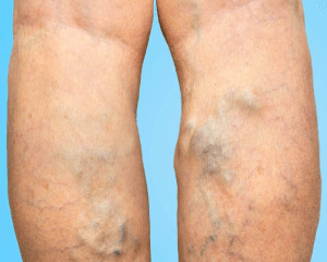 varicose veins