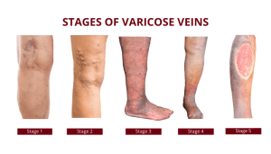 varicose veins stages